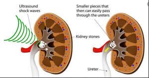 Nokta Üroloji Böbrek Taşı Kırma Merkezleri